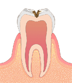 むし歯治療